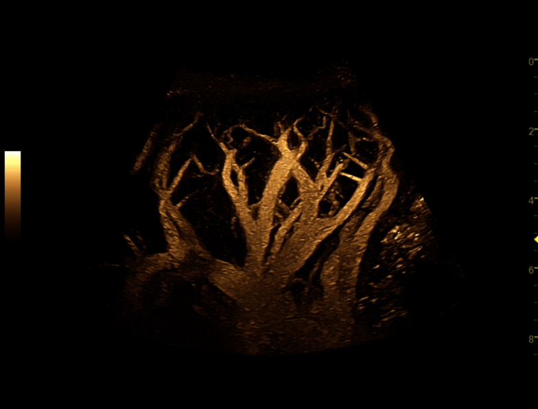 B-Flow imaging ultrasound image