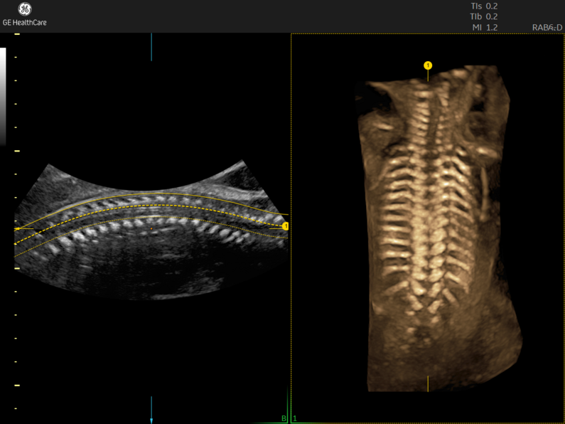Fetal spine ultrasound with a traced curvature line in B-mode on the left and a corresponding 3D rendered spine on the right.