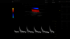 Ultrazvukový snímek: L312 karotida v barvě PW