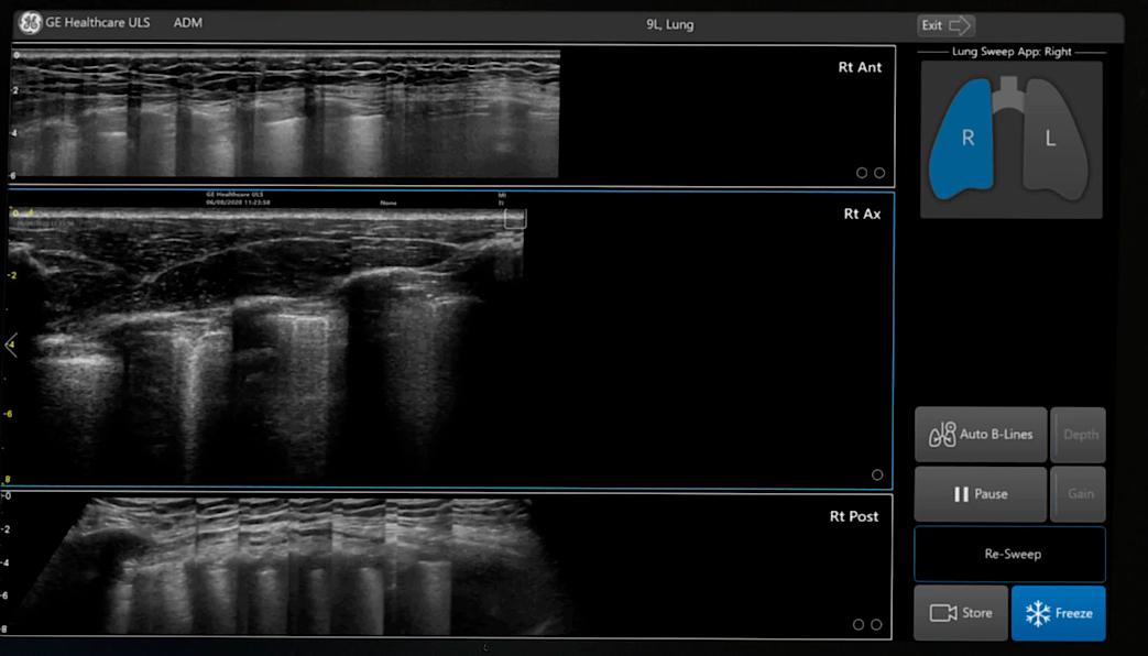 Ultrazvukový snímek zachycený pomocí funkce Lung Sweep
