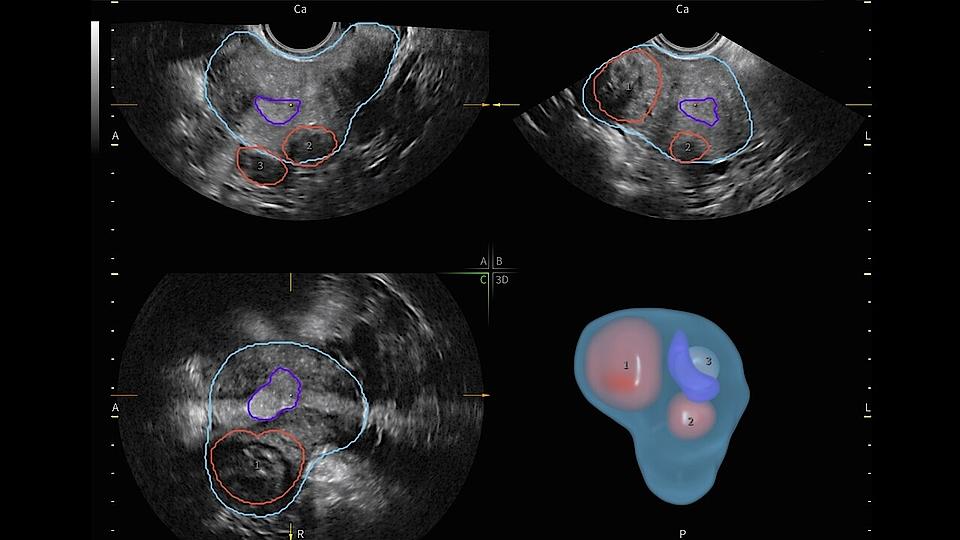 Ultraschallbild von Fibroid Mapping
