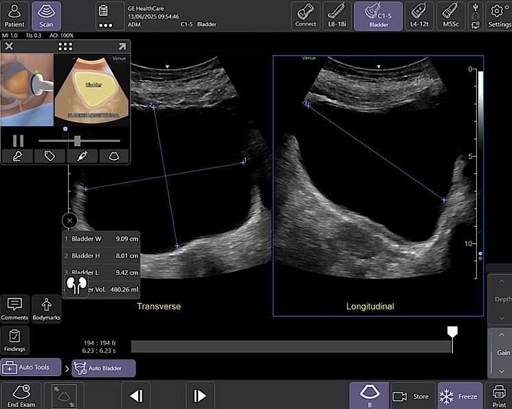 Auto Bladder Volume