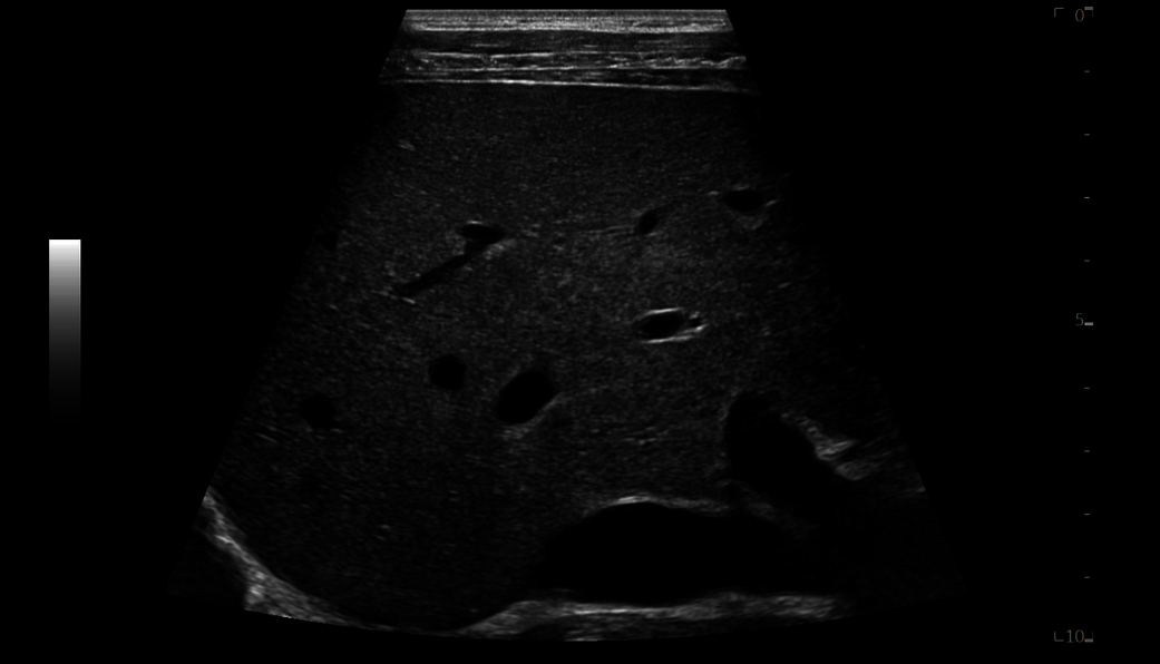 High resolution imaging of pediatric liver , ML4-20-D