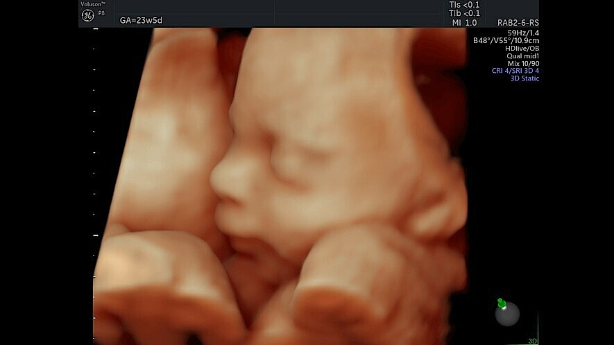 Ultrazvukový snímek obličeje plodu zachycený pomocí HDlive