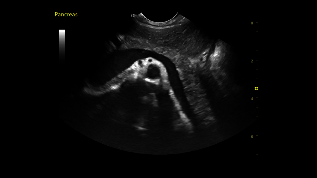 Pancreas abdomen, 8C-RS