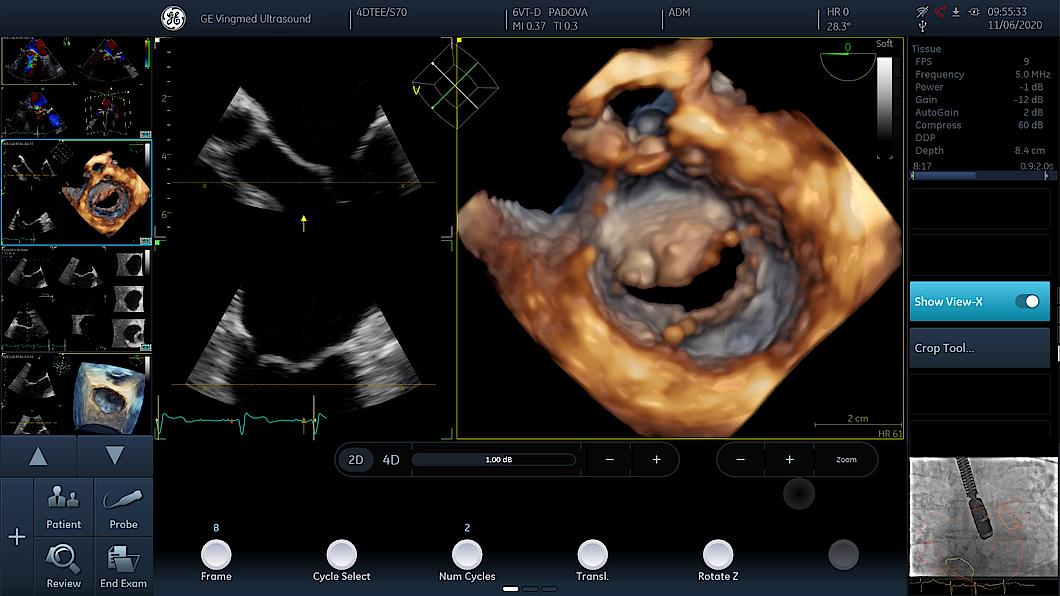 Ultrasound image captured using TEE imaging