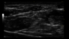 Ultrazvukový snímek n. medianus