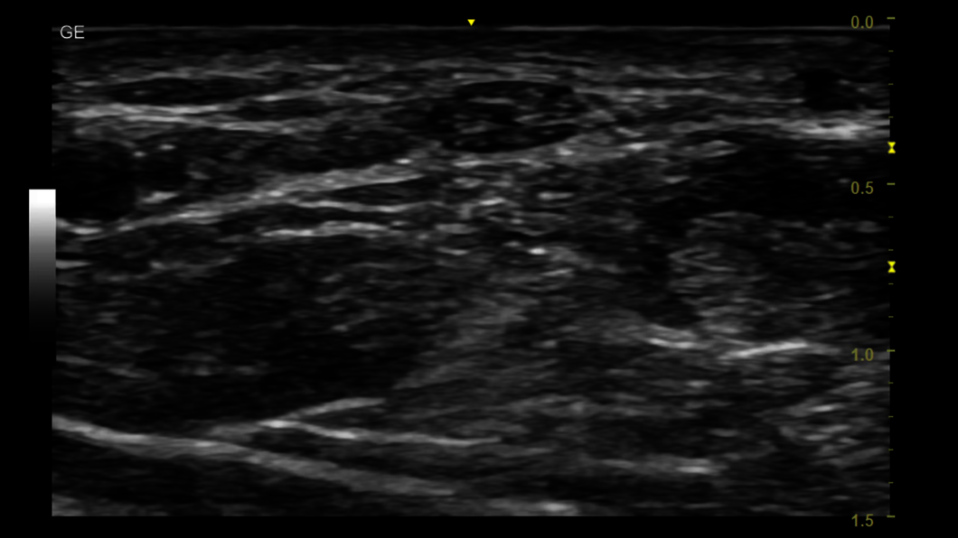 Ultraschallbild des Nervus medianus