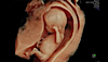Ultrasound image of a fetus captured using HDlive technologies