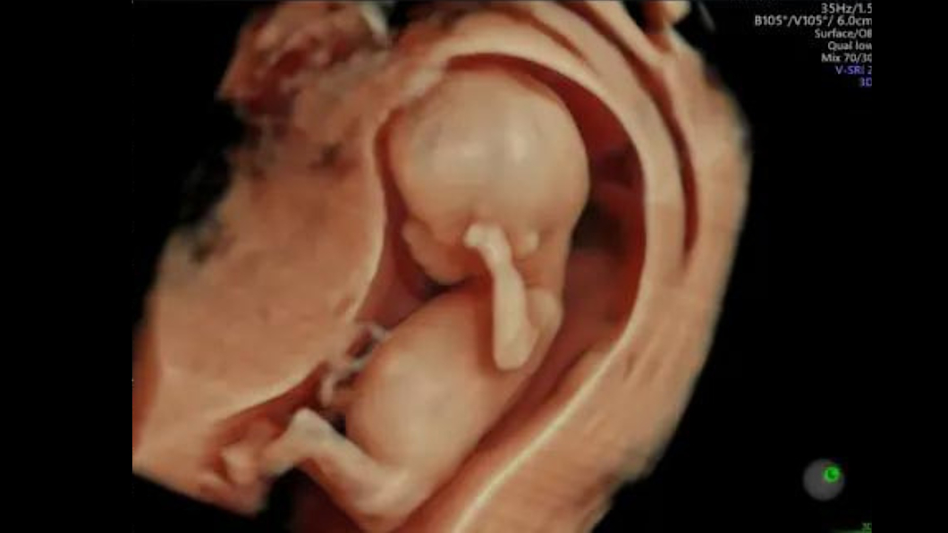 Ecografie ce prezintă un fetus, capturată cu tehnologia HDlive