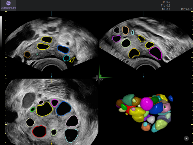 Multi-panel ultrasound showing SonoAVC follicle detection, with individual ovarian follicles outlined in different colors and rendered together in a color coded 3D volume.