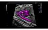 Image échographique du cœur du fœtus à l'aide de Radiantflow