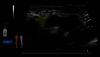 Ultrasound image captured with cNerve