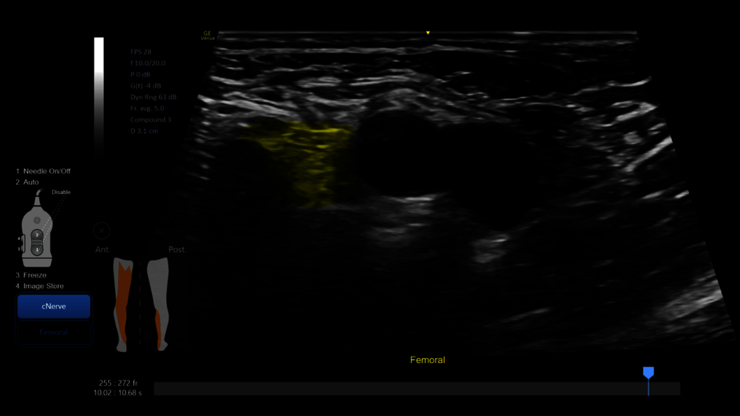Ultrasound image captured with cNerve