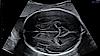 Υπερηχογραφική εικόνα της κεφαλής του εμβρύου