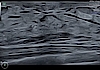 Ultraschallbild Mammasonographie mit hochauflösendem B-Bild