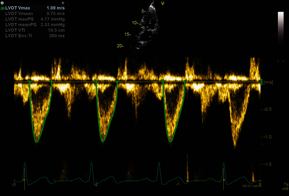 Klinický snímek zachycený pomocí aplikace AI Cardiac Auto Doppler