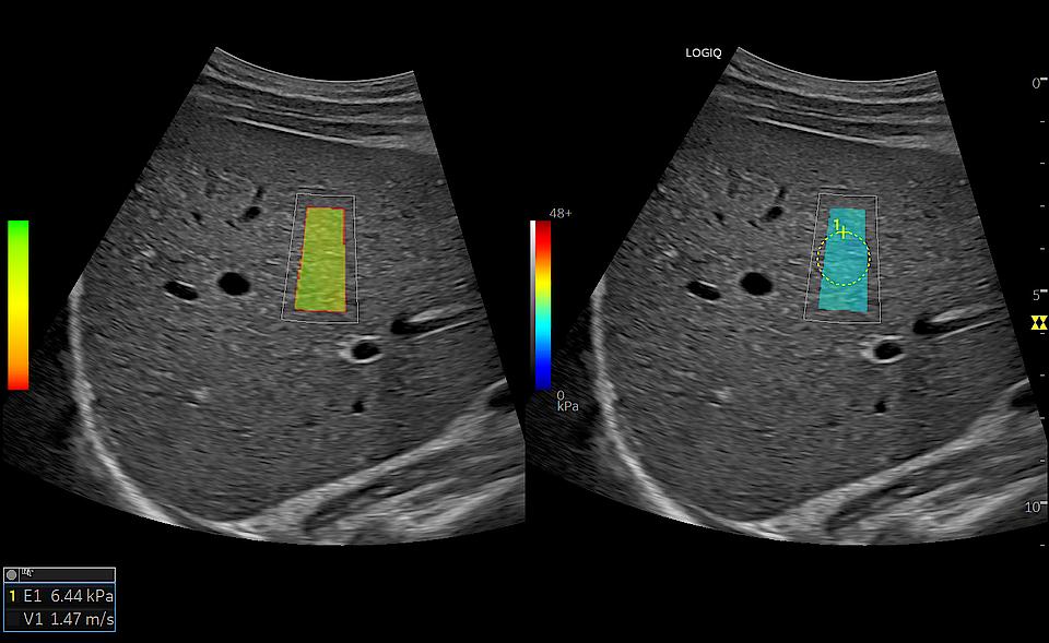 Ultrasound image captured using 2D Shear Wave Elastography