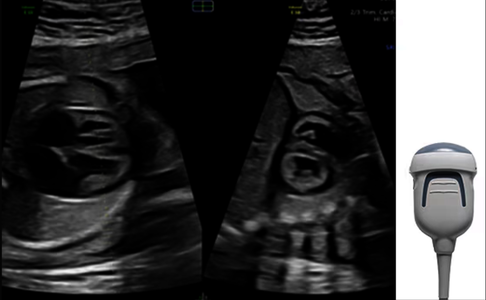 Ultrasound image captured with eM6C matrix probe