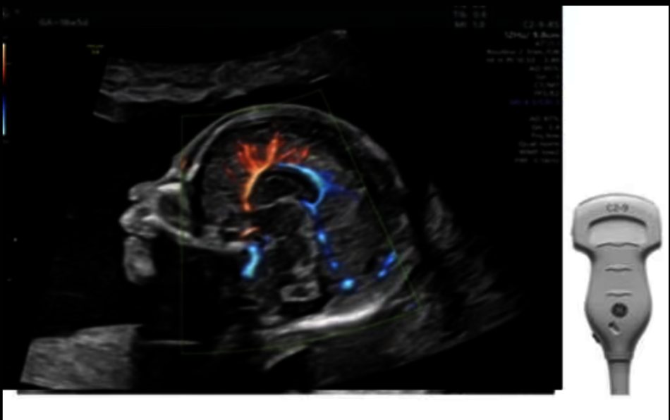 Ultrazvukový snímek plodu zachycený pomocí sondy C2-9