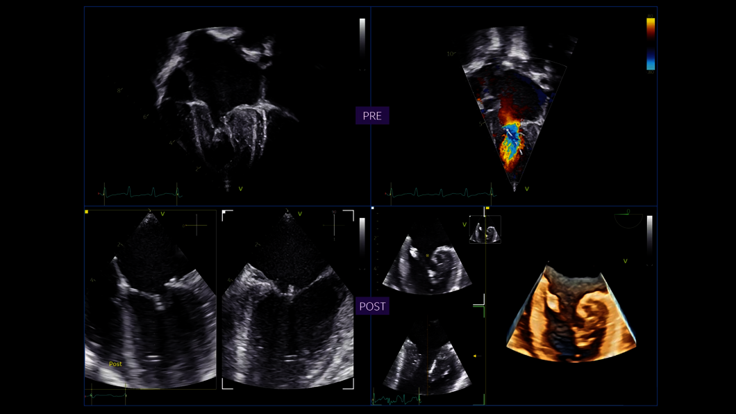 Pre- and post-interventional procedure. Mitral stenosis with 9VT-D probe