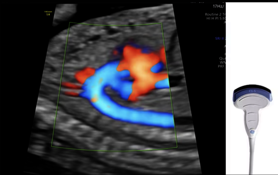 Ultrazvukový snímek zachycený pomocí sondy C1-5-RS