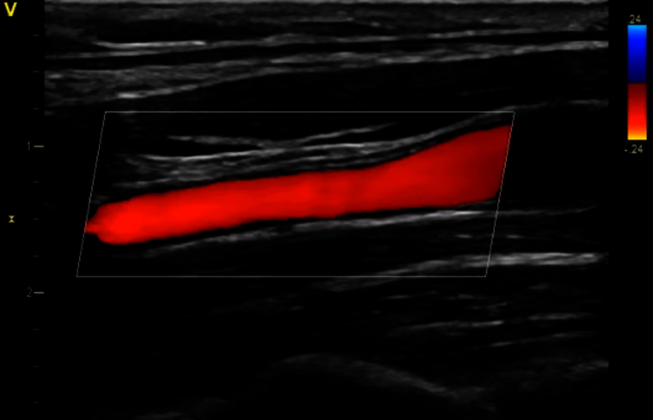 Klinický snímek zachycený pomocí zobrazení průtoku krve