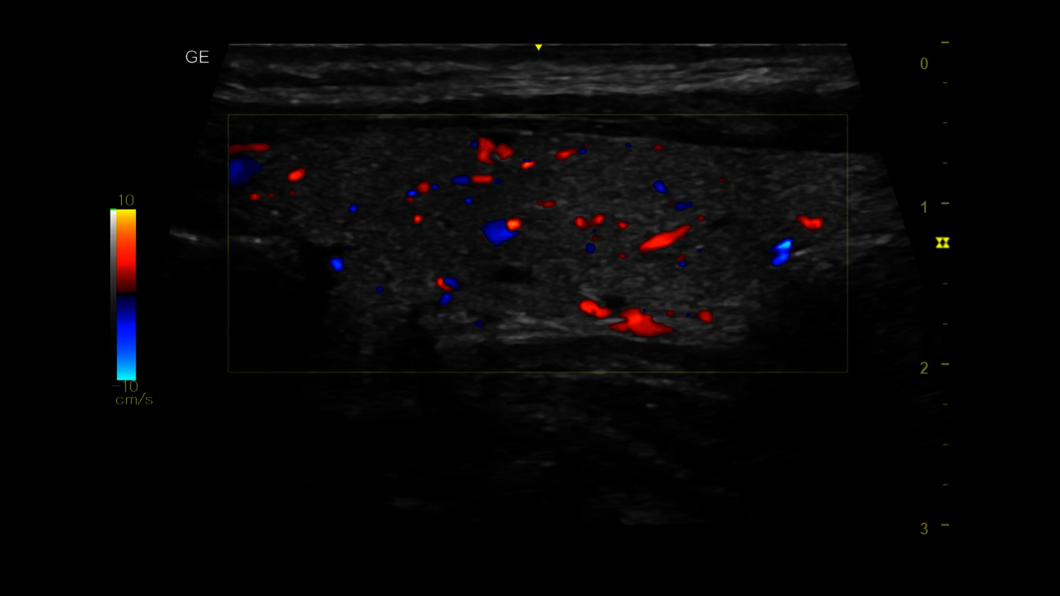 Clinical image of a thyroid ultrasound exam captured using color Doppler
