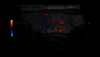 Image clinique d'un examen échographique de la thyroïde en Doppler couleur