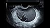 Ultrasound image complex ovarian mass