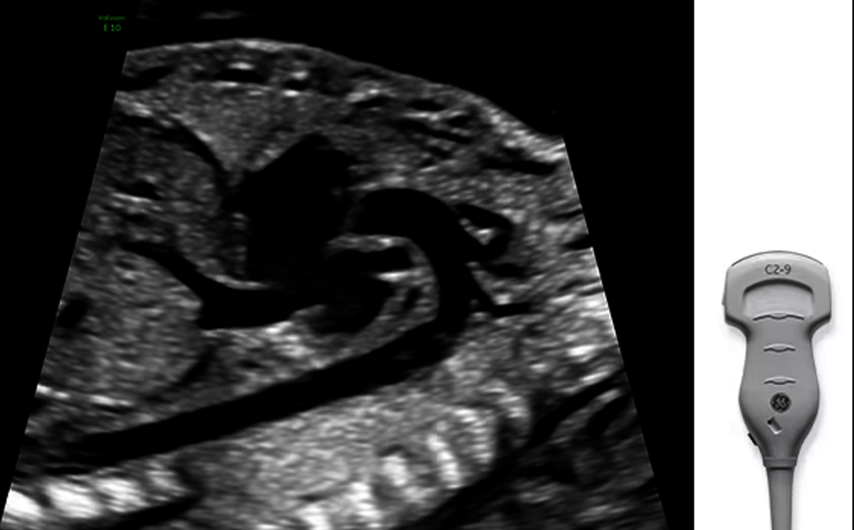 Ultrazvukový snímek zachycený pomocí sondy XDclear.