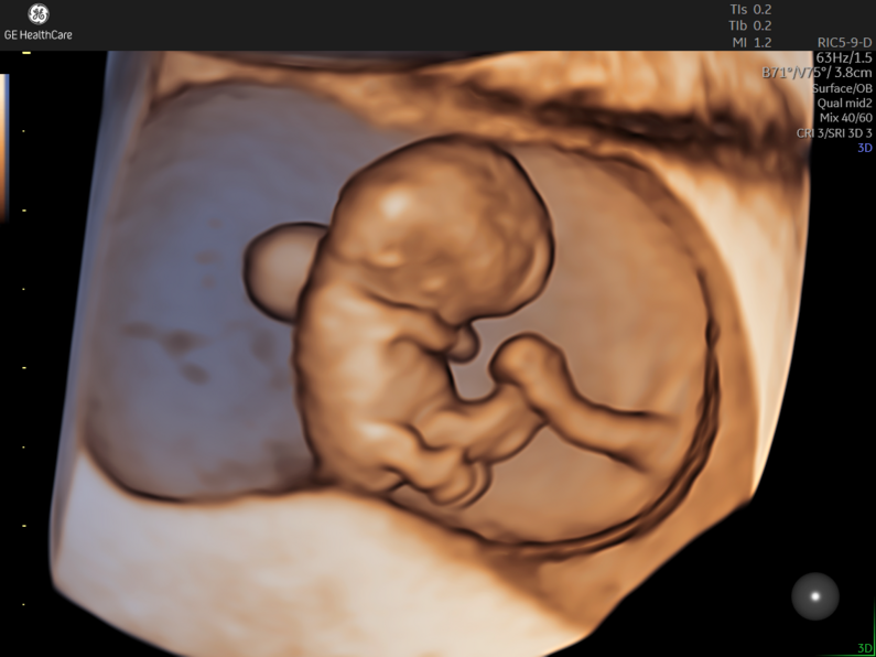 3D rendered ultrasound image of a 9 week fetus within the gestational sac.
