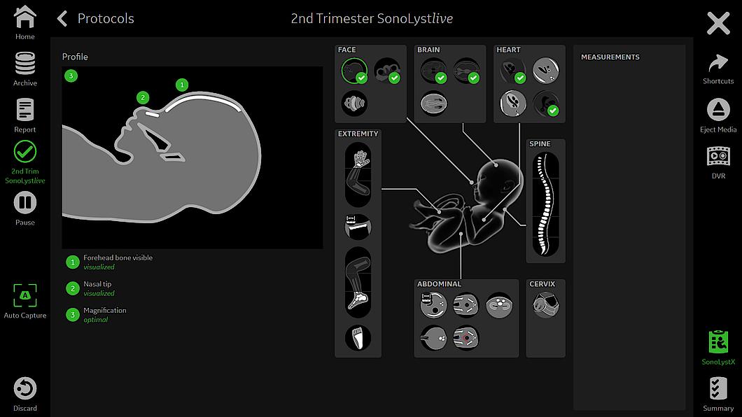 clinical image with SonoLystlive