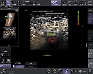 Nervblox Clinical image