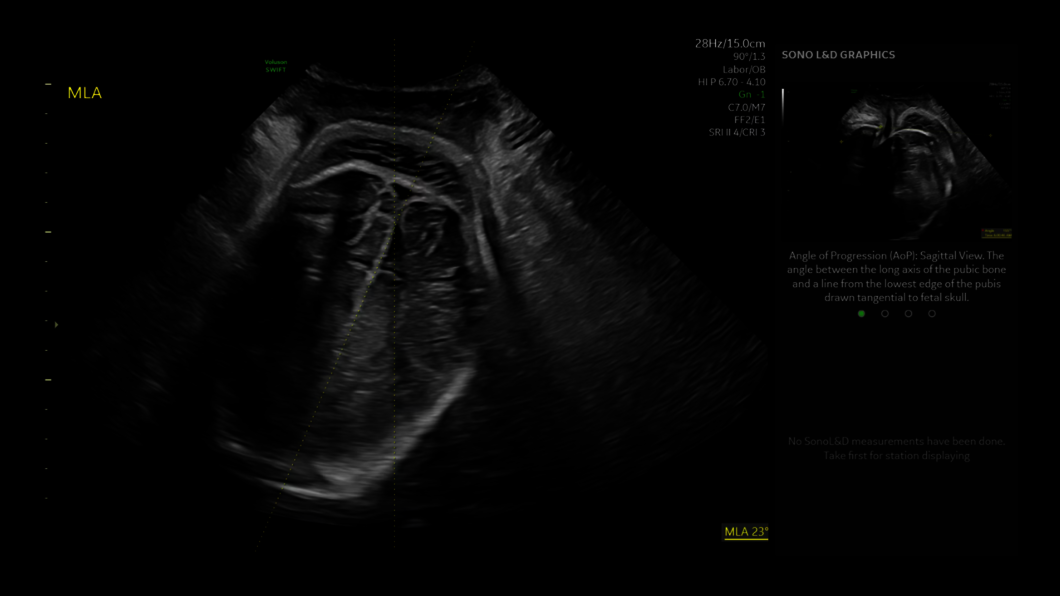 Ultrazvukový snímek: Správa úhlu střední linie Sono L&D