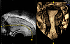 3D ultrasound image of the female uterus