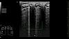 Ultrazvukový snímek zachycený pomocí nástroje Auto B-lines.