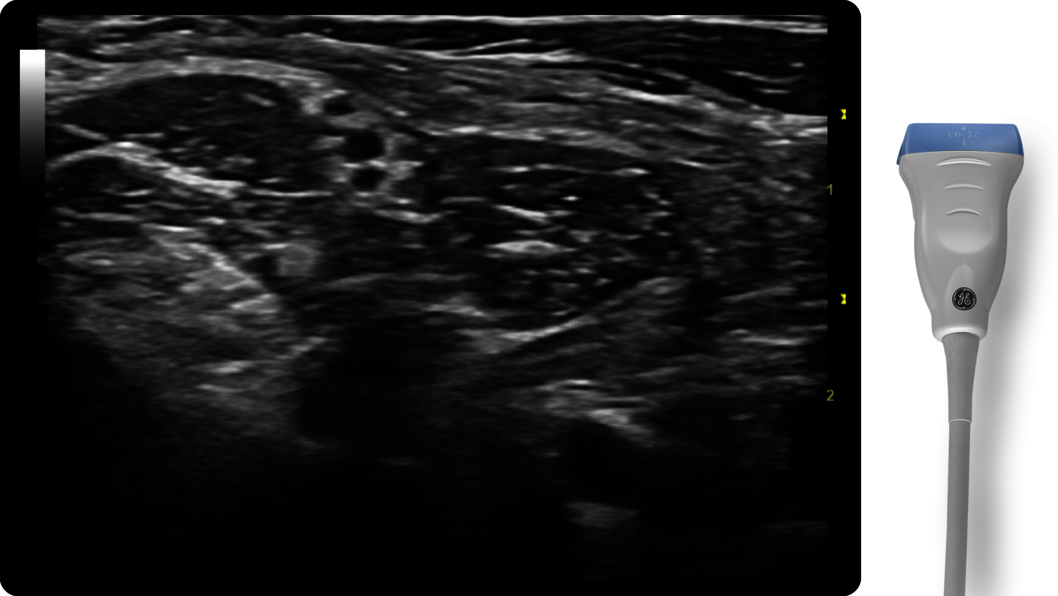 Short axis view of Rotator Interval with L6-12 probe