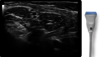 Short axis view of Rotator Interval with L6-12 probe