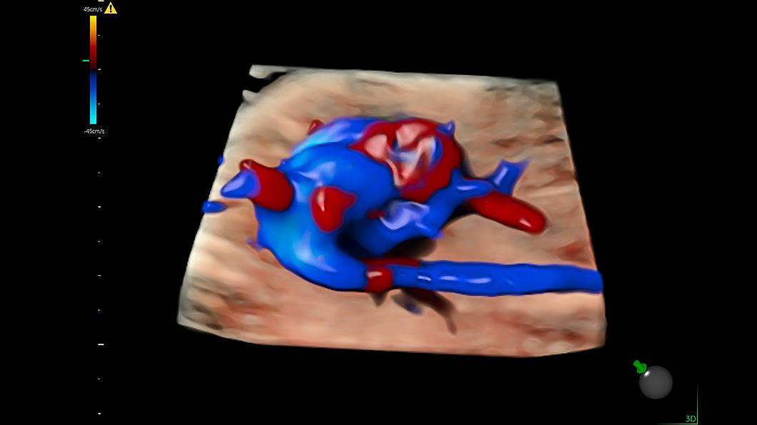 Fetal heart with hdlive flow