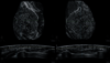 Ultrazvukový snímek extrémně denzní prsní tkáně