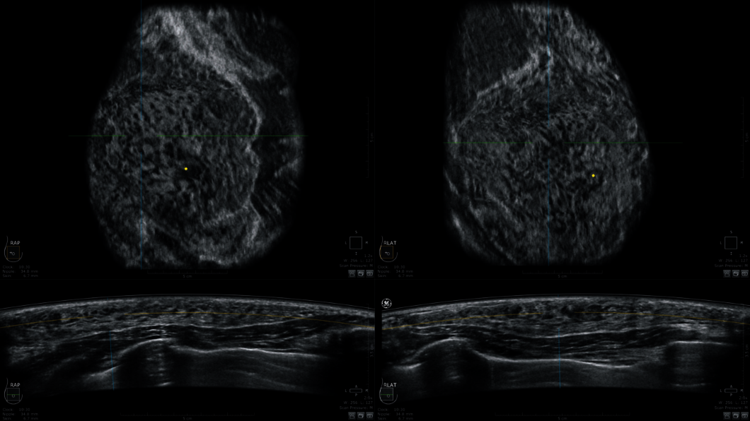 Ultraschallbild einer weiblichen Brust mit extrem dichtem Brustgewebe