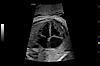 Coupe des 4 cavités Cardiologie Foetale , C1-6-D