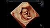 Ultrasound image of a 10-week fetus