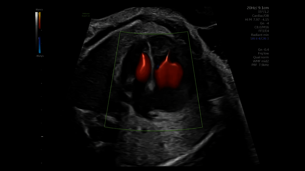 Ultrasound image of a fetal heart captured using Radiantflow
