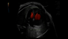 Ultraschallbild eines fetalen Herzens mit Radiantflow