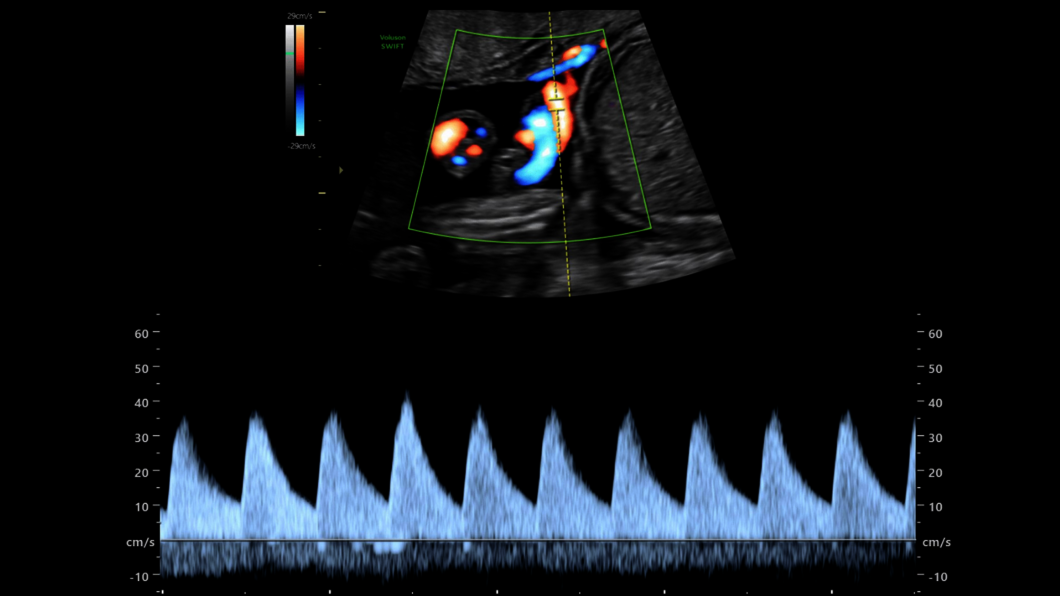 Ultrazvukový snímek: Doppler a. umbilicalis