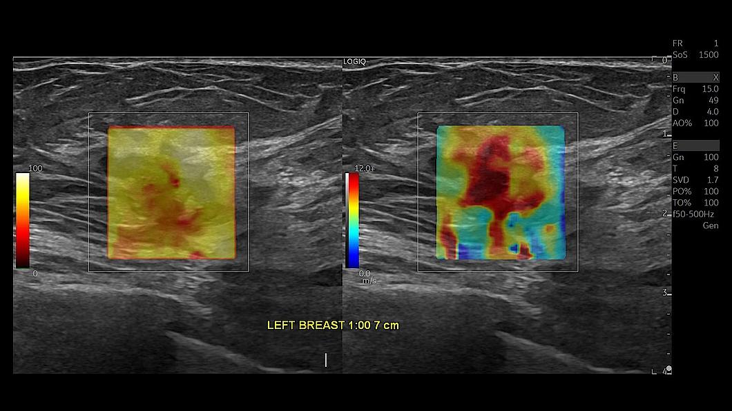 Lésion mammaire avec élastographie par ondes de cisaillement 2D, ML4-20-D