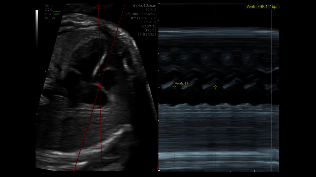 Ultrasound image: SonoFHR