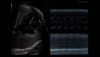 Ultraschallbild: SonoFHR